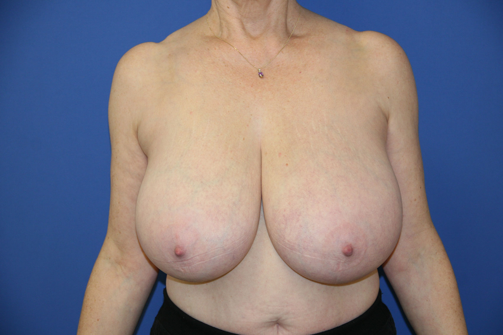 breast-reduction-9-front - MPS
